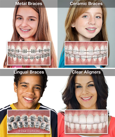 4 types of dental braces