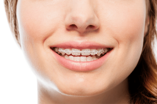 Top Reasons to Straighten Your Teeth in 2024