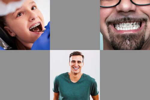 What Is a Good Age to Get Braces?