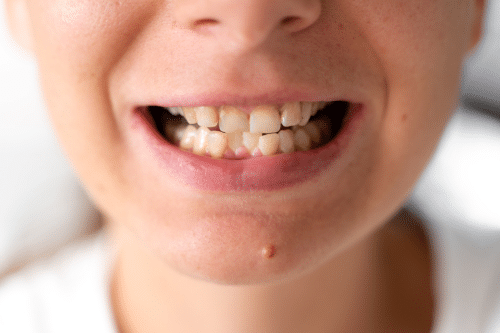What Is the Best Treatment for Crowded Teeth in New York?