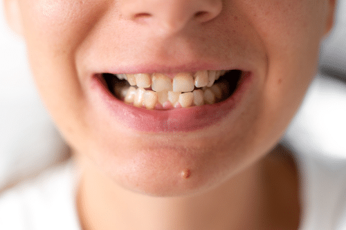 Crowded Teeth in New York